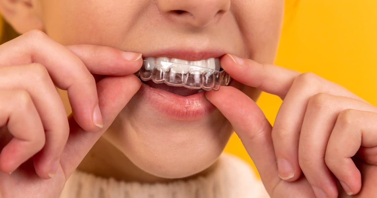 Dental Implant Recovery: A Week-by-Week Guide - Dent Health, Banjara Hills, Hyderabad