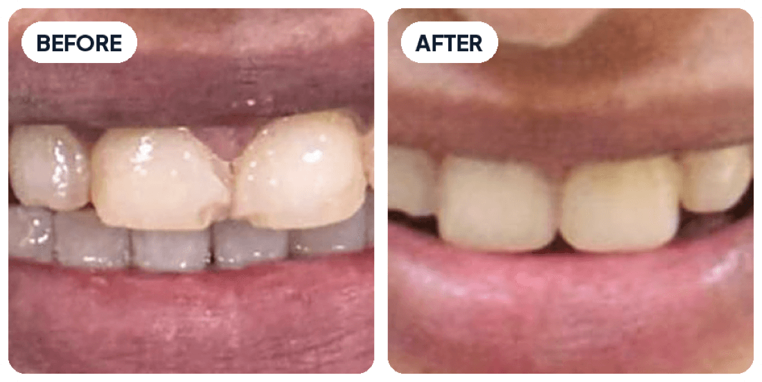 Real patient before and after: chipped front tooth restored