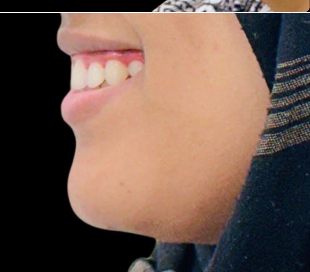 After braces & invisalign at Dent Health, Banjara Hills, Hyderabad - Protruding front teeth drawn back into a balanced profile and lip line.