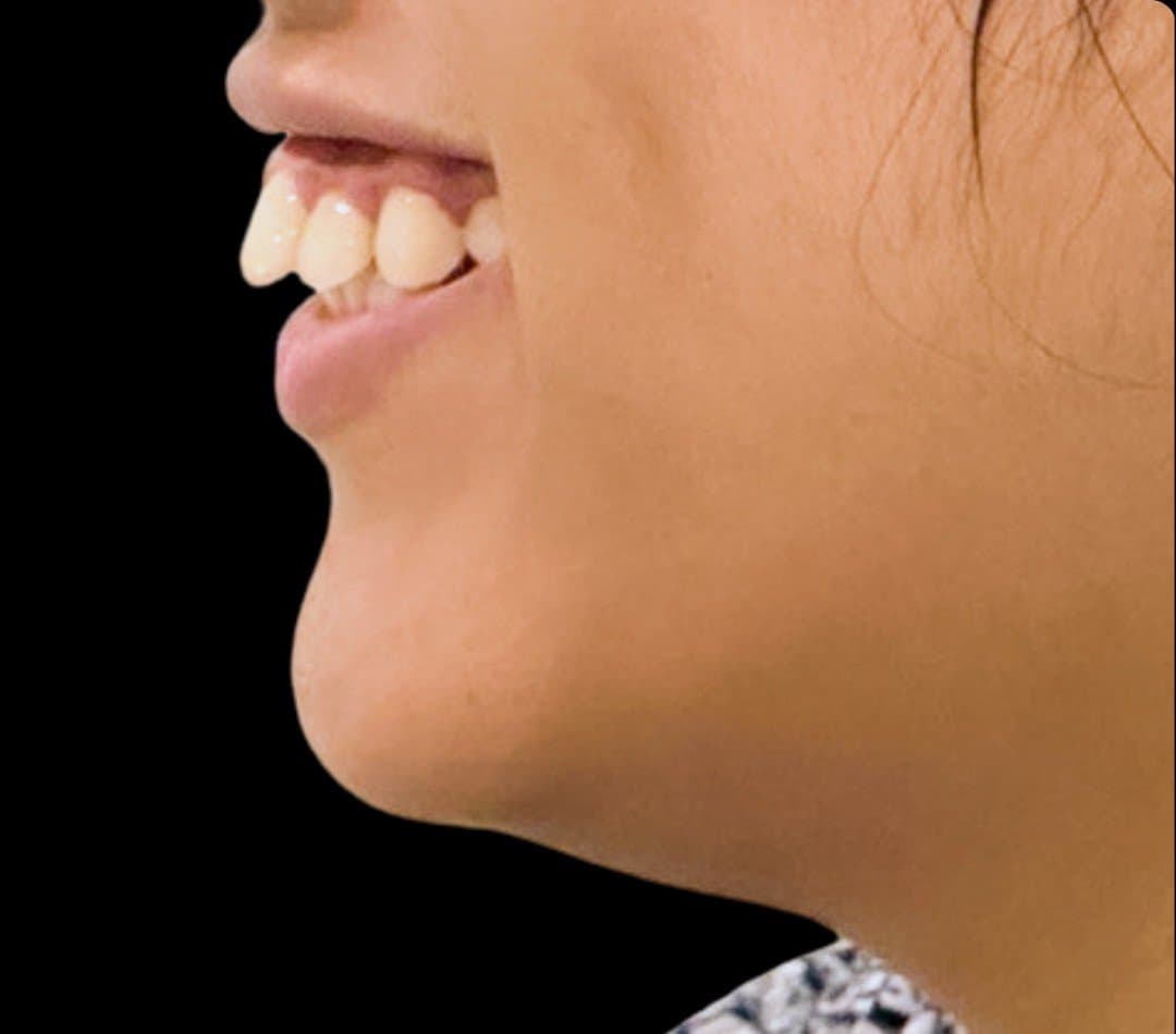 Before braces & invisalign at Dent Health, Banjara Hills, Hyderabad - Protruding front teeth drawn back into a balanced profile and lip line.