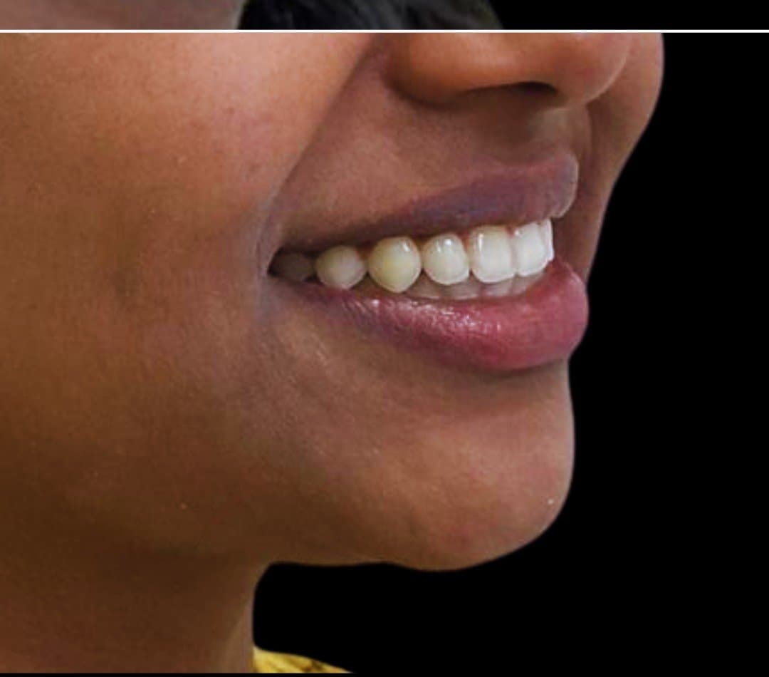 After braces & invisalign at Dent Health, Banjara Hills, Hyderabad - Spaced, protruding teeth aligned into an even, confident smile.