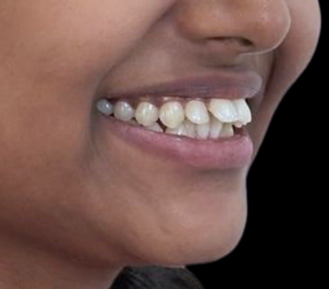 Before braces & invisalign at Dent Health, Banjara Hills, Hyderabad - Spaced, protruding teeth aligned into an even, confident smile.