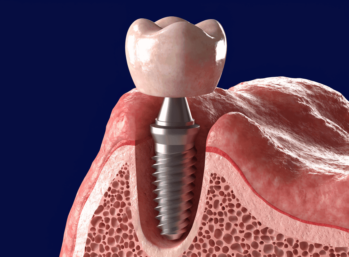 Anatomical cutaway of a dental implant in the jawbone showing the titanium screw, abutment and ceramic crown