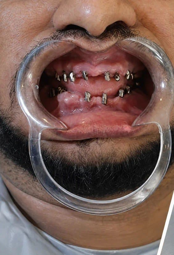 Implant posts - dental implants at Dent Health, Banjara Hills, Hyderabad