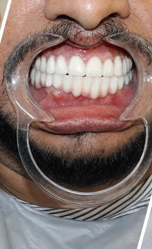 Teeth fitted - dental implants at Dent Health, Banjara Hills, Hyderabad