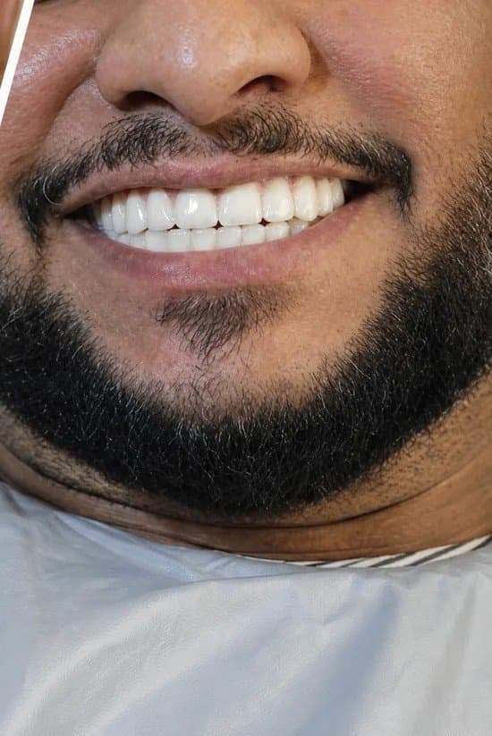 After - dental implants at Dent Health, Banjara Hills, Hyderabad