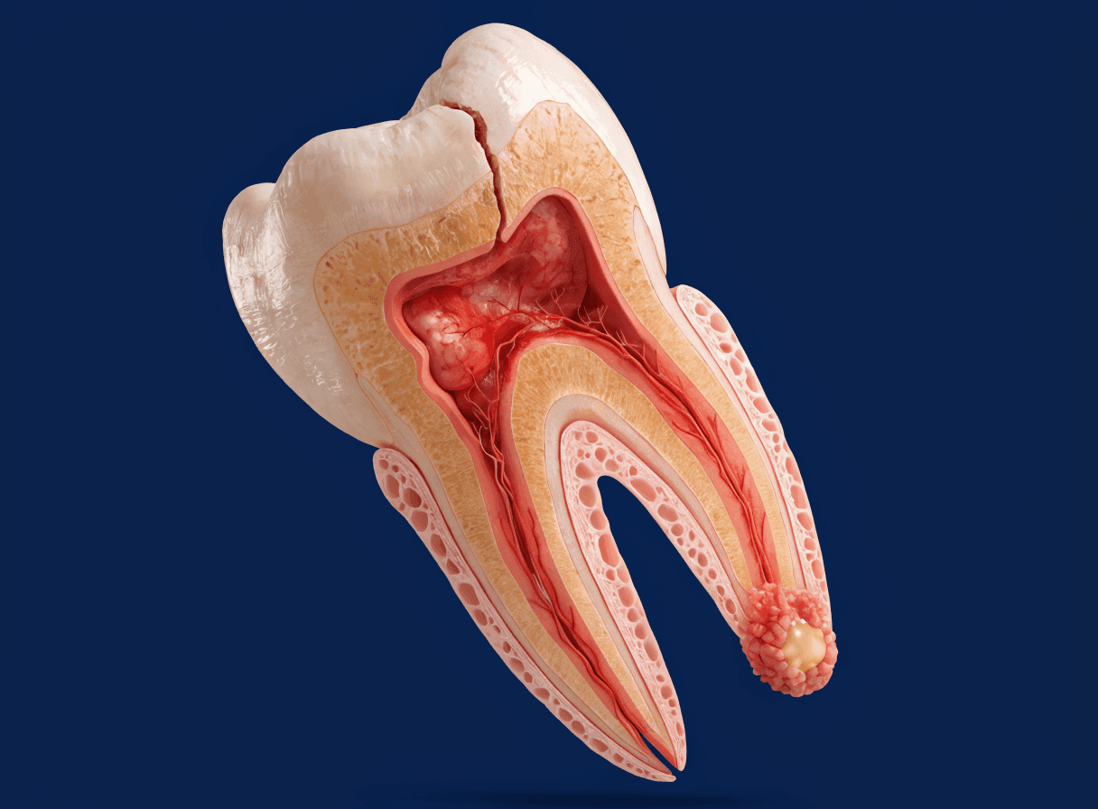 Anatomical cutaway of a cracked tooth with exposed inflamed pulp and an abscess