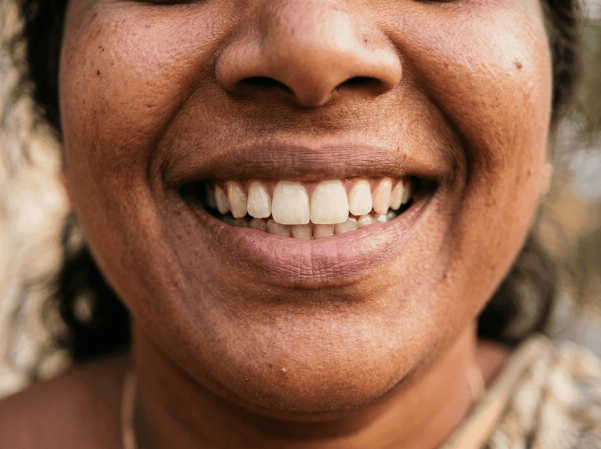 After emergency dentistry at Dent Health, Banjara Hills, Hyderabad - A chipped front tooth repaired and made whole again.