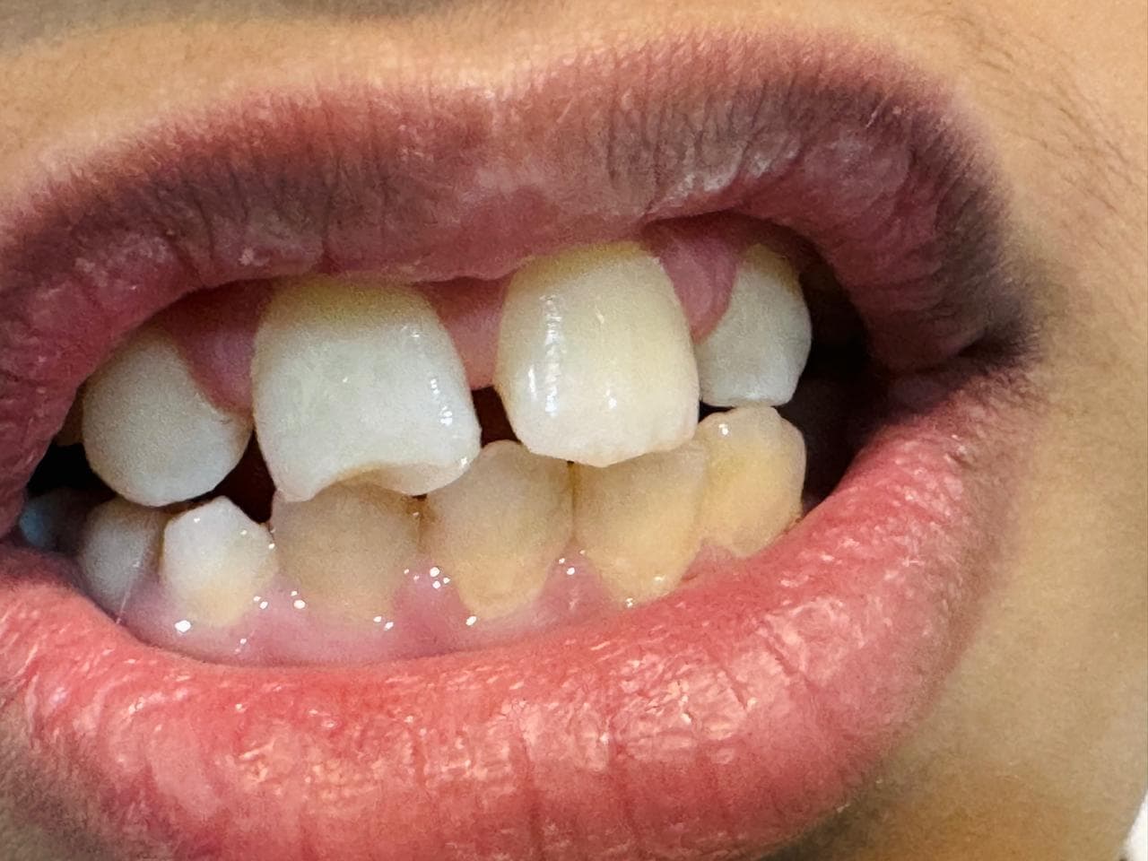 Before - pediatric dentistry at Dent Health, Banjara Hills, Hyderabad