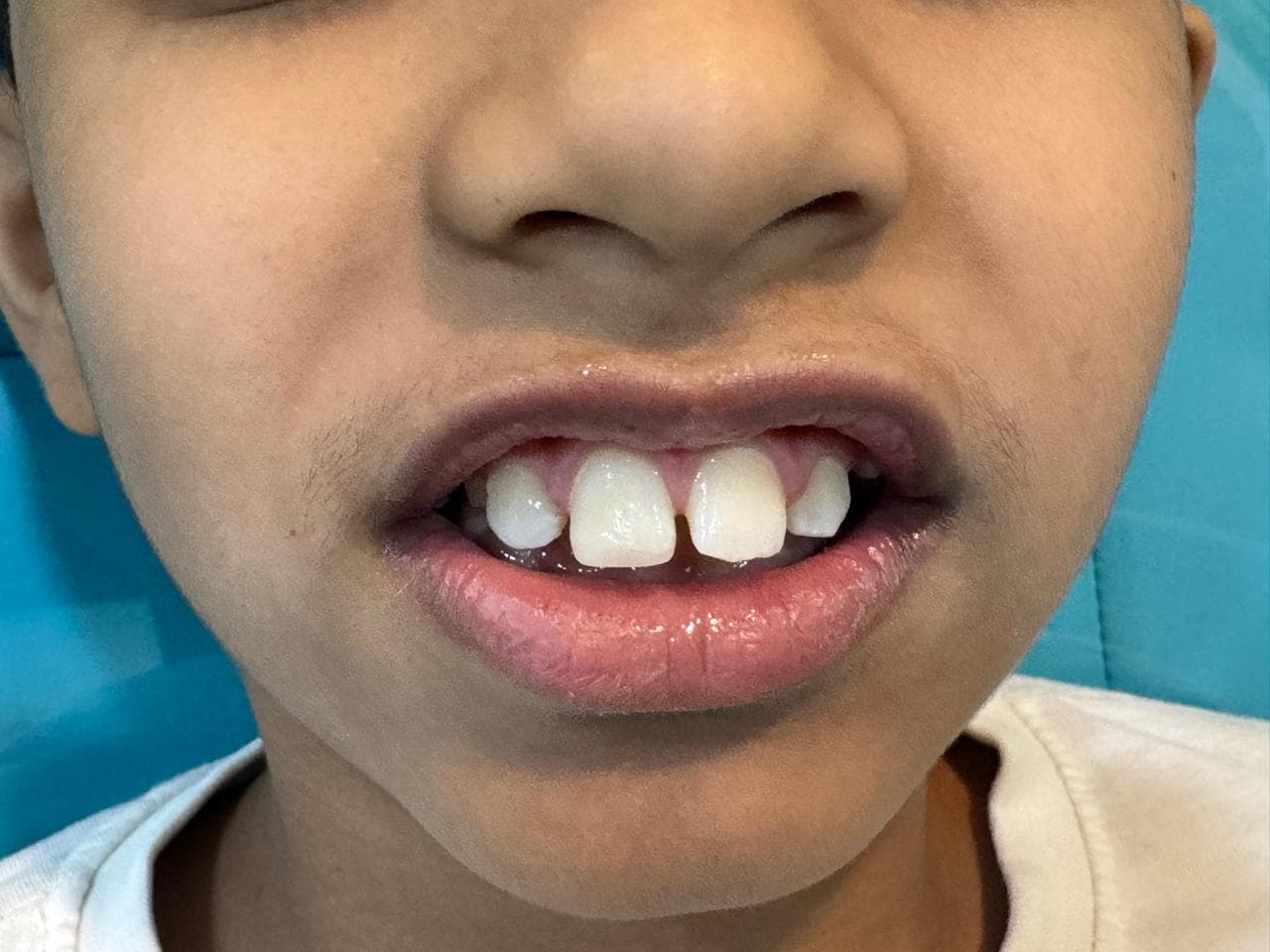 After - pediatric dentistry at Dent Health, Banjara Hills, Hyderabad