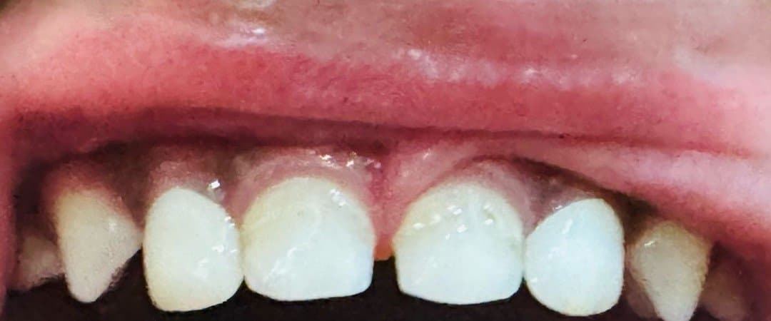 After pediatric dentistry at Dent Health, Banjara Hills, Hyderabad - Badly decayed, broken milk teeth rebuilt into bright, healthy front teeth. Drag to compare.