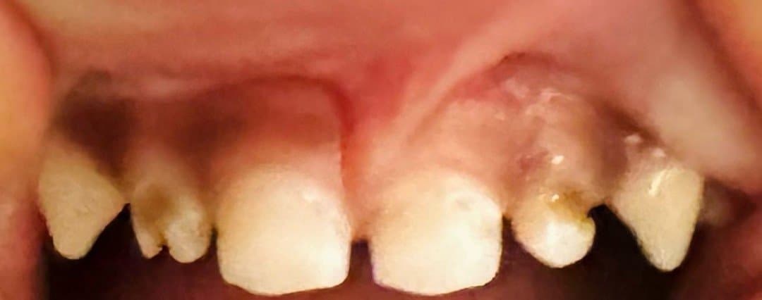 Before pediatric dentistry at Dent Health, Banjara Hills, Hyderabad - Badly decayed, broken milk teeth rebuilt into bright, healthy front teeth. Drag to compare.