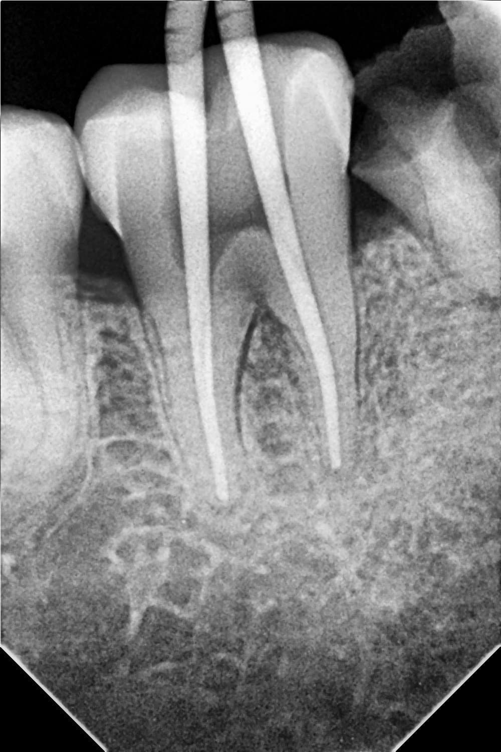 Sealed canals - root canal treatment at Dent Health, Banjara Hills, Hyderabad