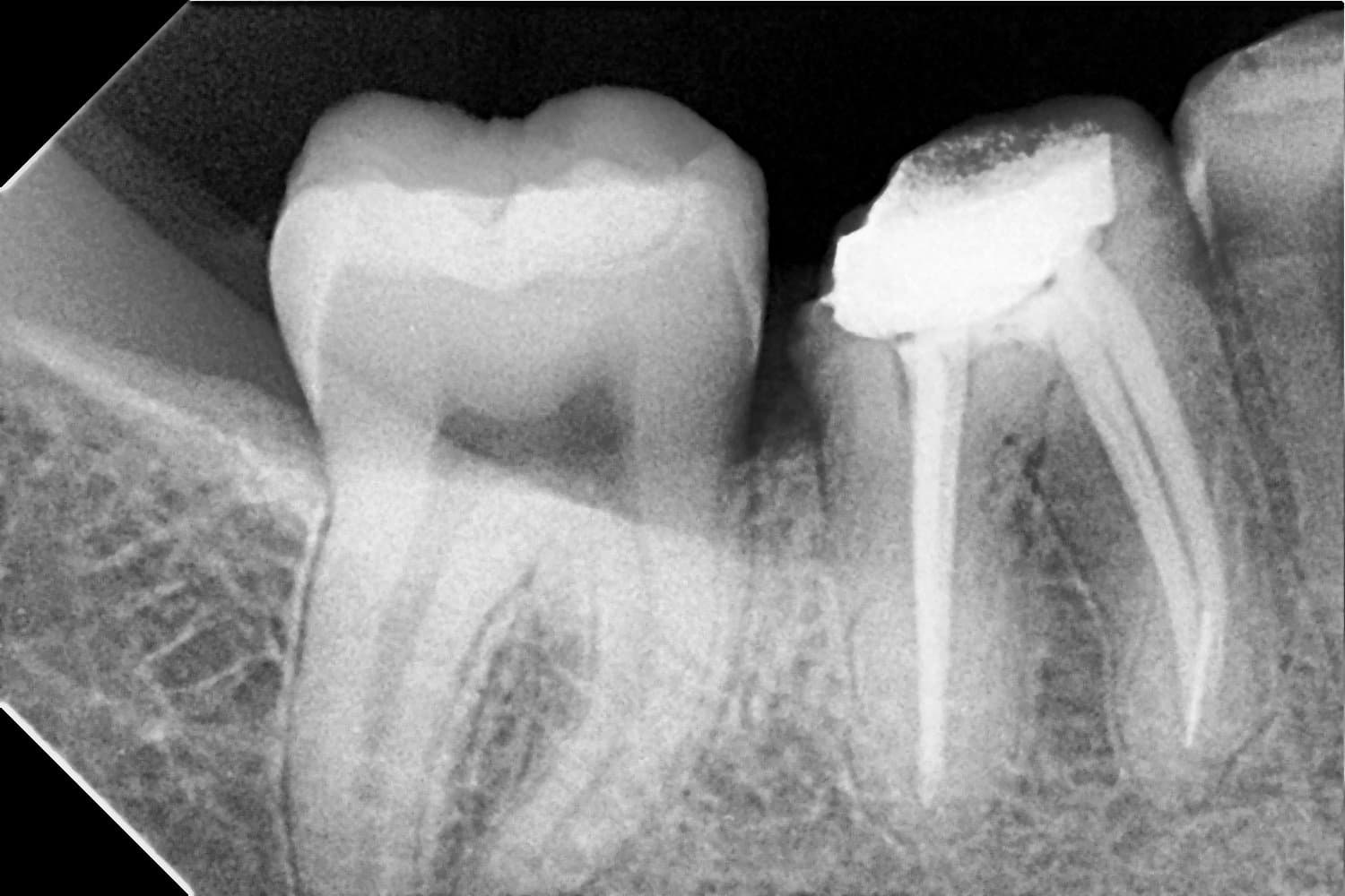 Sealed canals - root canal treatment at Dent Health, Banjara Hills, Hyderabad