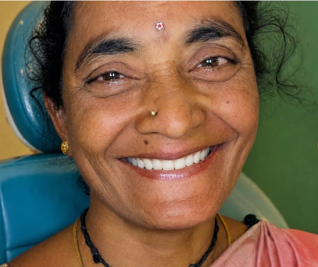 After smile makeover at Dent Health, Banjara Hills, Hyderabad - A worn, ageing smile rebuilt into a full, even set of teeth. Drag to compare.