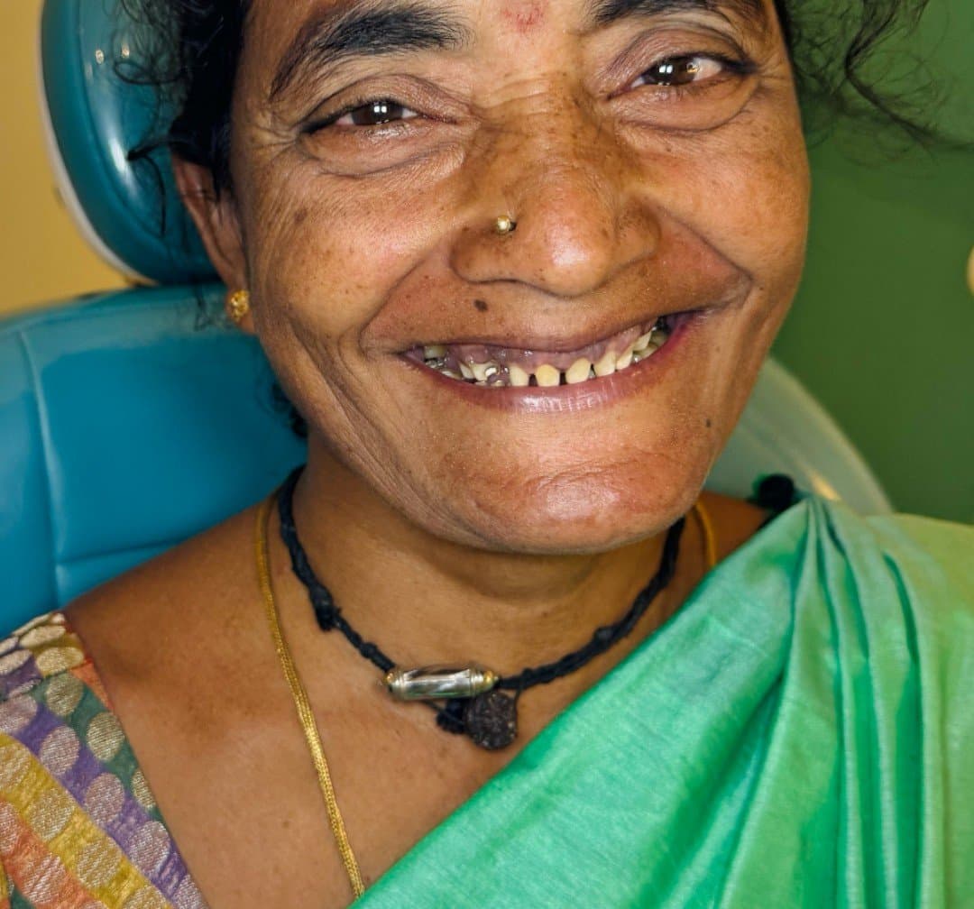 Before smile makeover at Dent Health, Banjara Hills, Hyderabad - A worn, ageing smile rebuilt into a full, even set of teeth. Drag to compare.