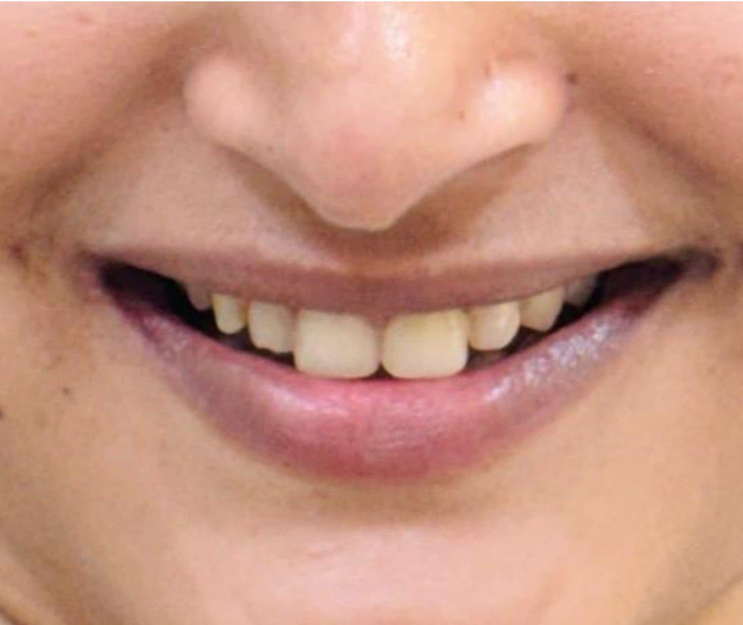 After smile makeover at Dent Health, Banjara Hills, Hyderabad - Chipped, uneven front teeth reshaped into a smooth, balanced smile. Drag to compare.