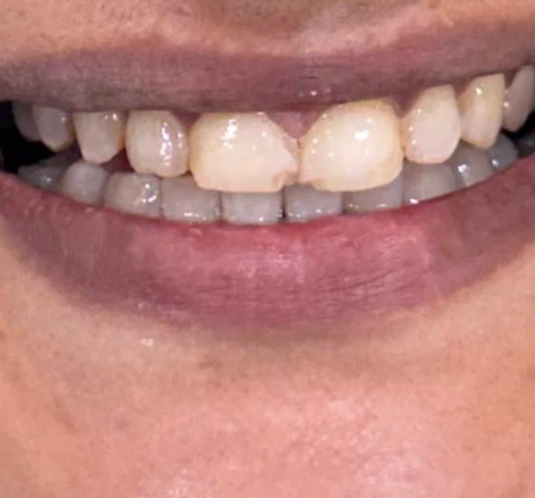 Before smile makeover at Dent Health, Banjara Hills, Hyderabad - Chipped, uneven front teeth reshaped into a smooth, balanced smile. Drag to compare.