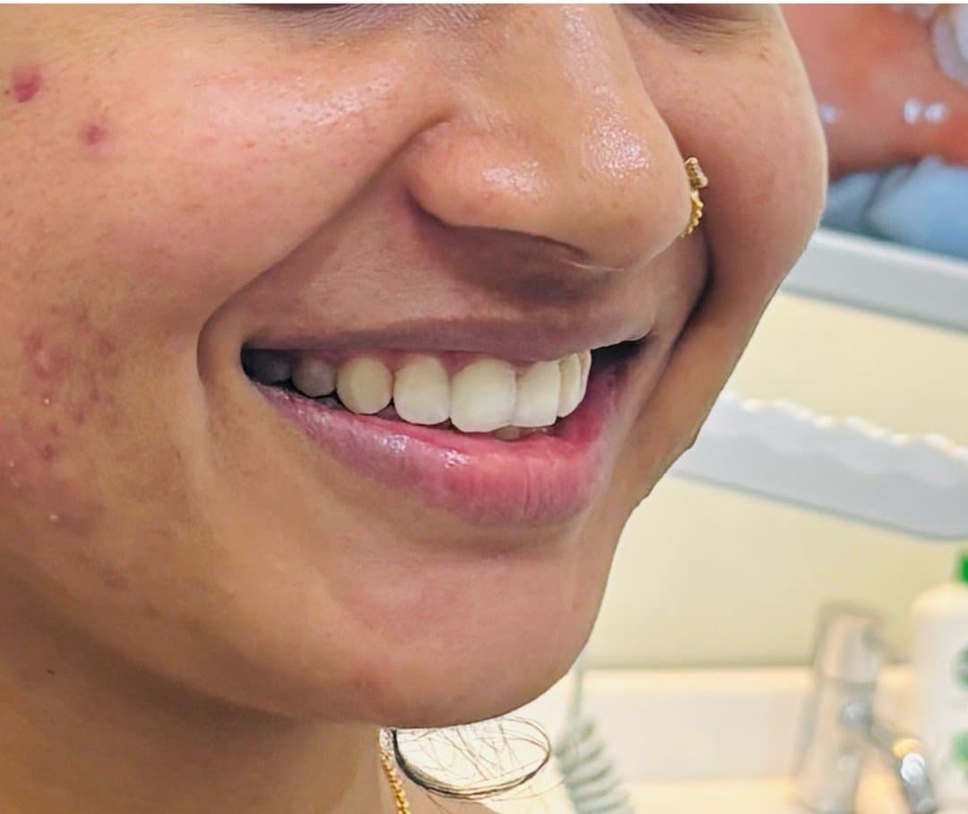 After smile makeover at Dent Health, Banjara Hills, Hyderabad - A gap and uneven front teeth refined into a confident, even smile. Drag to compare.
