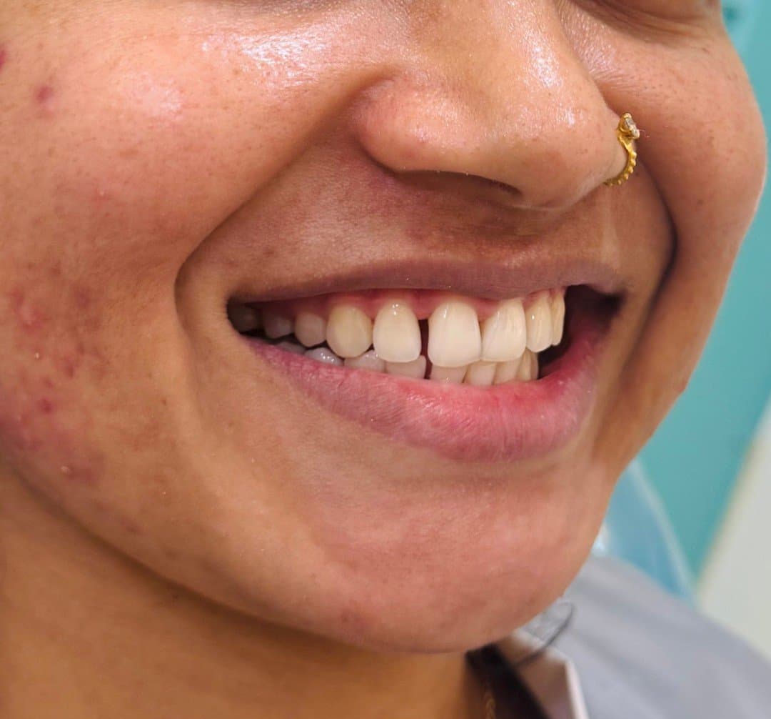 Before smile makeover at Dent Health, Banjara Hills, Hyderabad - A gap and uneven front teeth refined into a confident, even smile. Drag to compare.