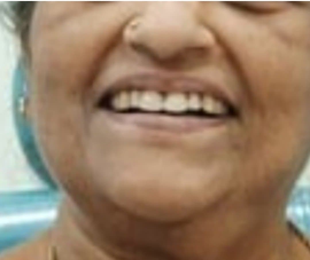 After smile makeover at Dent Health, Banjara Hills, Hyderabad - Worn and missing teeth restored into a complete, natural smile. Drag to compare.