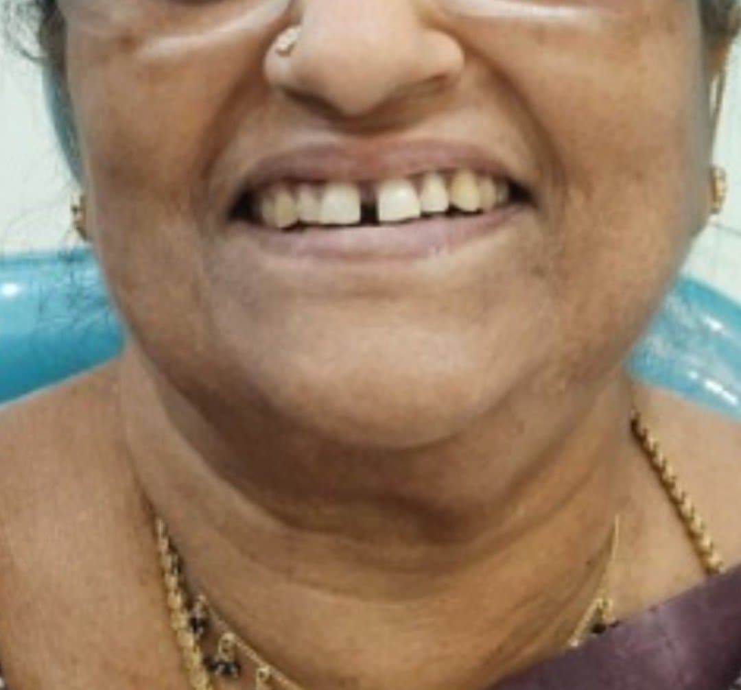 Before smile makeover at Dent Health, Banjara Hills, Hyderabad - Worn and missing teeth restored into a complete, natural smile. Drag to compare.