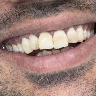 After smile makeover at Dent Health, Banjara Hills, Hyderabad