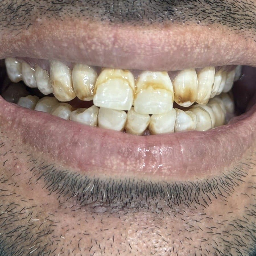 Before smile makeover at Dent Health, Banjara Hills, Hyderabad