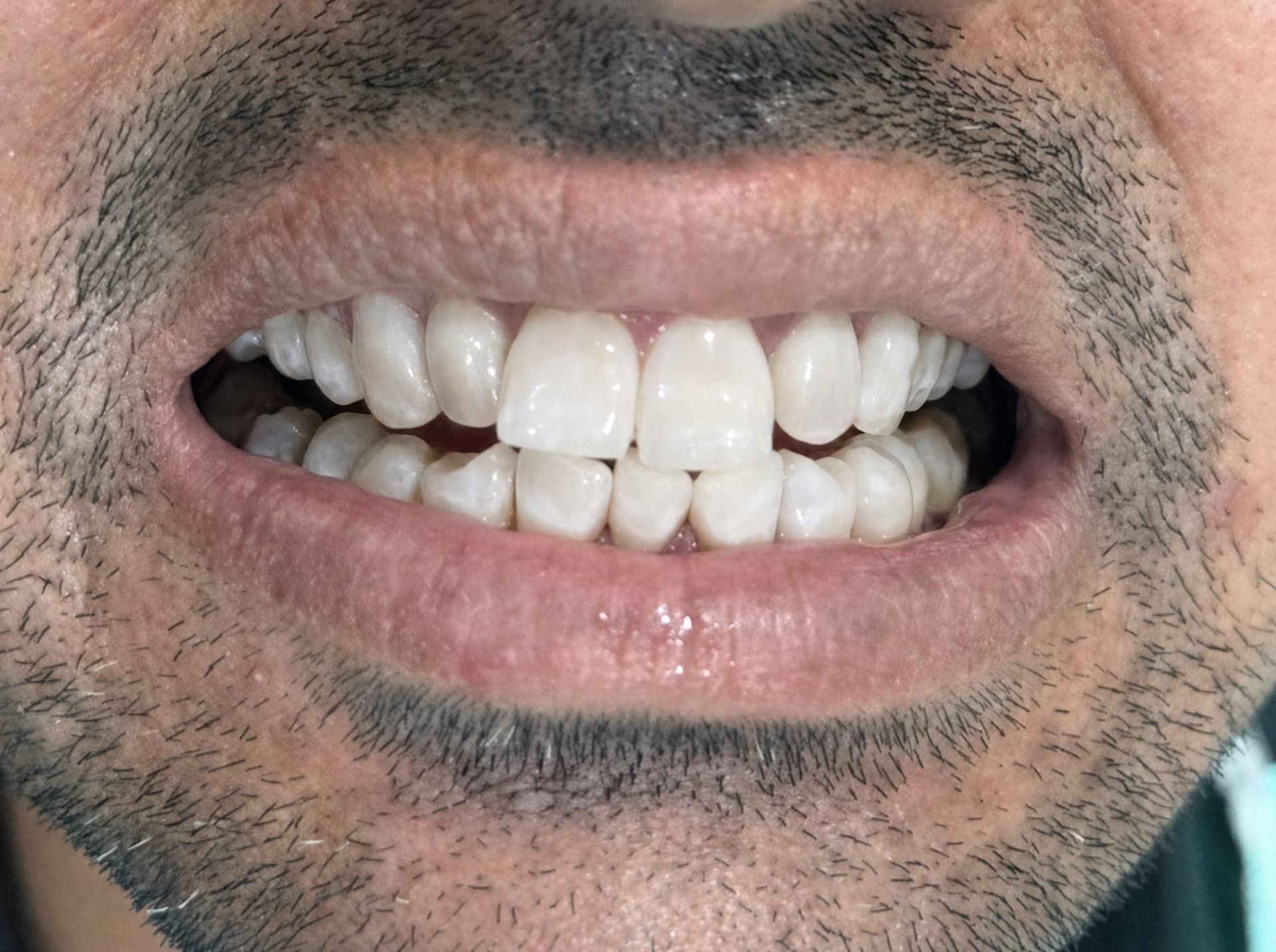 After teeth whitening at Dent Health, Banjara Hills, Hyderabad - Heavy brown staining and tartar lifted to a clean, natural white. Drag to compare.