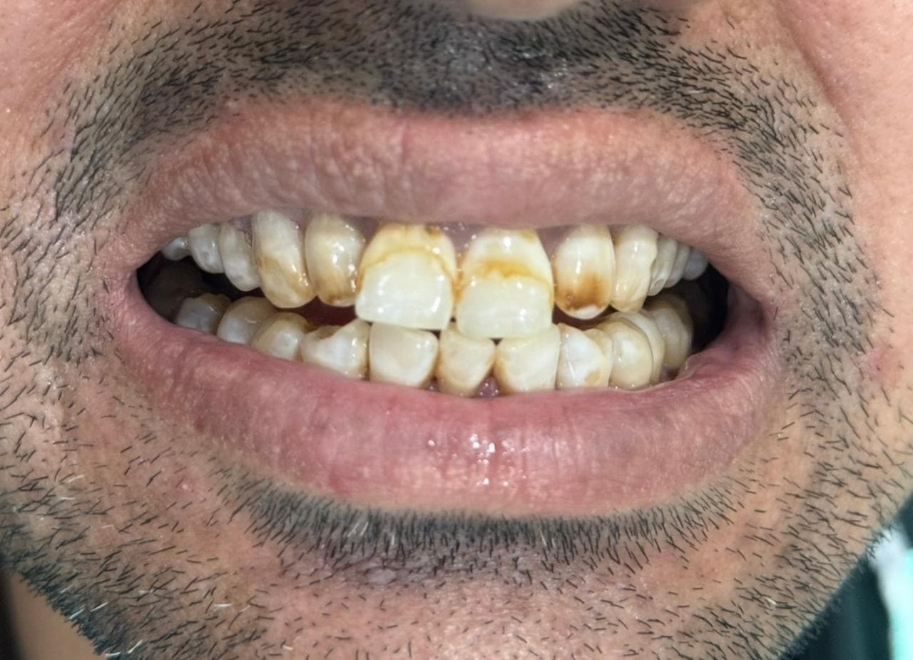 Before teeth whitening at Dent Health, Banjara Hills, Hyderabad - Heavy brown staining and tartar lifted to a clean, natural white. Drag to compare.