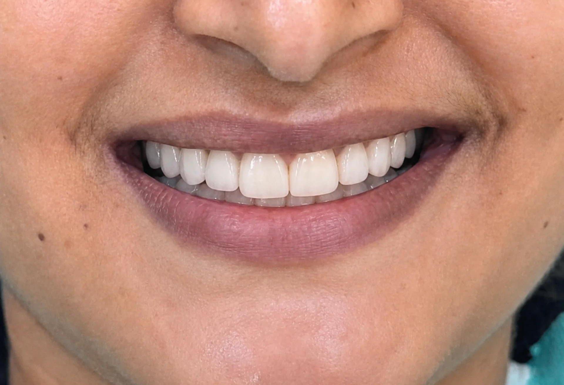 After cosmetic dentistry at Dent Health, Banjara Hills, Hyderabad - Crooked, gapped front teeth transformed with veneers. Drag to compare. After cosmetic dentistry at Dent Health, Banjara Hills, Hyderabad - Crooked, gapped front teeth transformed with veneers. Drag to compare.