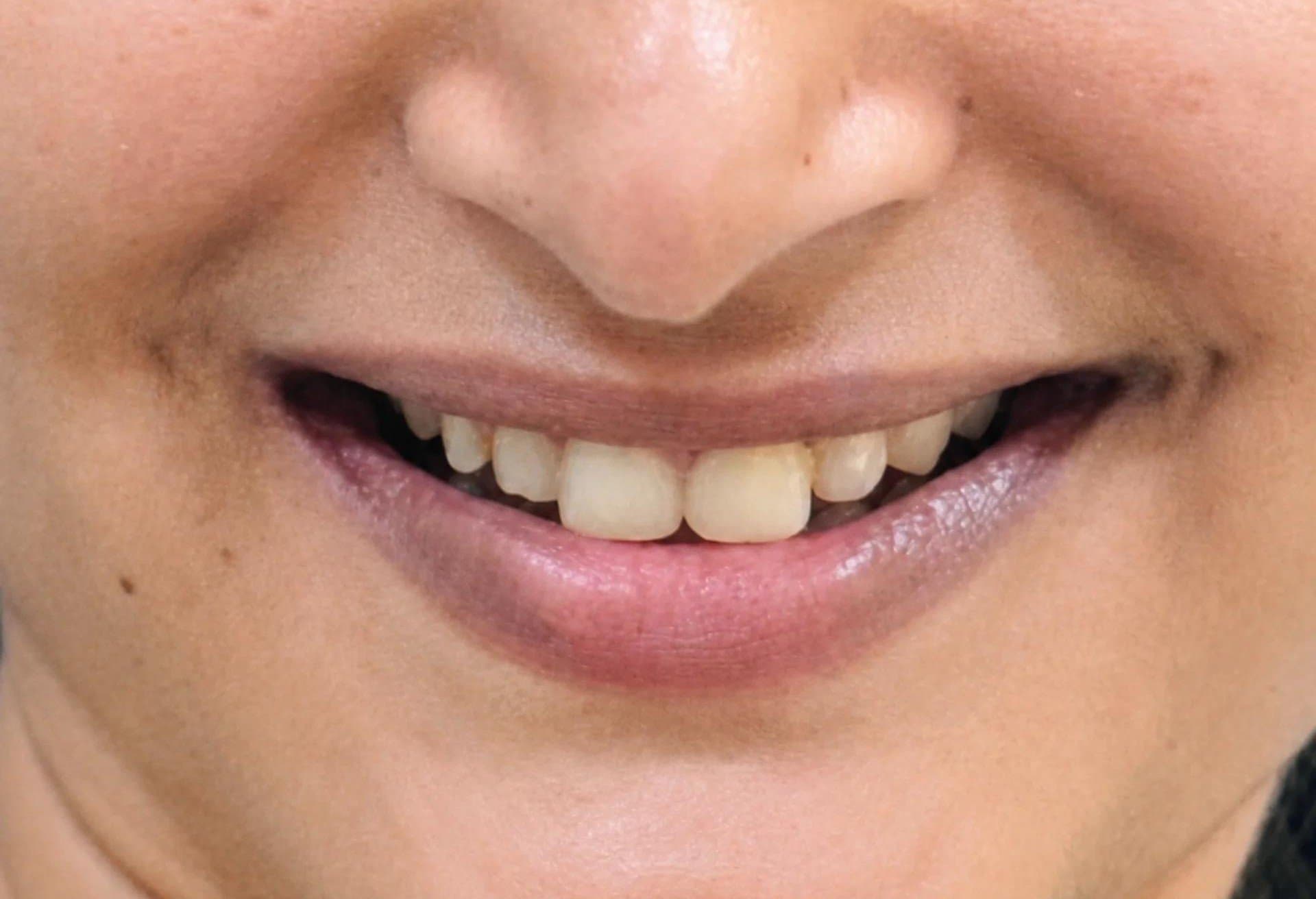 Before cosmetic dentistry at Dent Health, Banjara Hills, Hyderabad - Crooked, gapped front teeth transformed with veneers. Drag to compare. Before cosmetic dentistry at Dent Health, Banjara Hills, Hyderabad - Crooked, gapped front teeth transformed with veneers. Drag to compare.