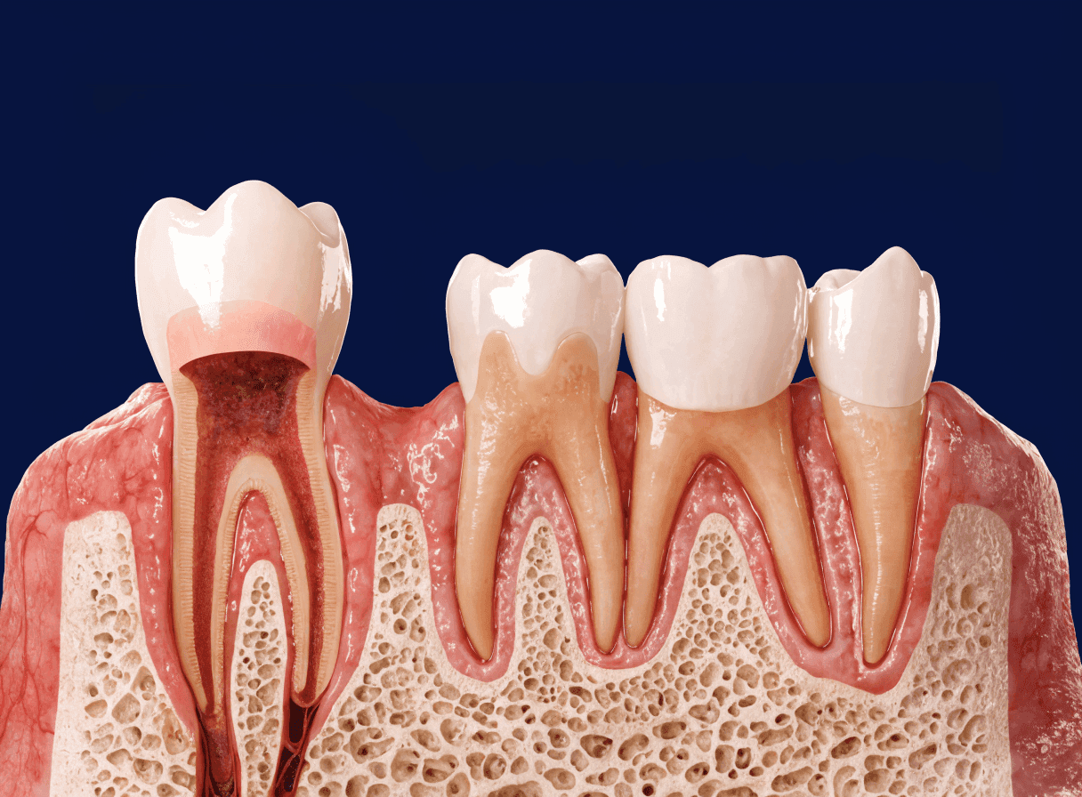 Anatomical cutaway of a crown capping a prepared tooth beside a bridge spanning a gap Anatomical cutaway of a crown capping a prepared tooth beside a bridge spanning a gap