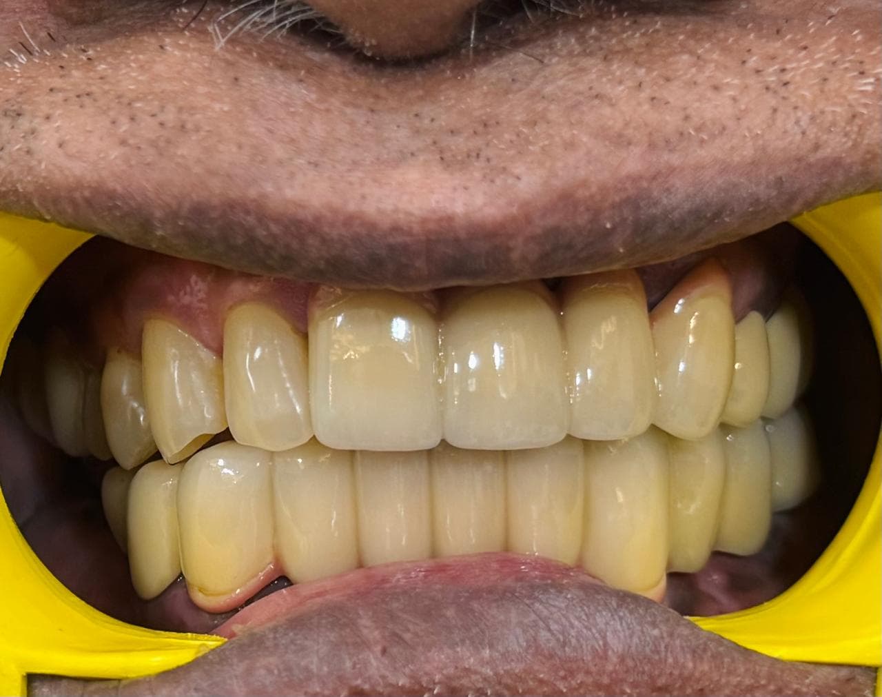 After crowns & bridges at Dent Health, Banjara Hills, Hyderabad - Missing and decayed upper teeth rebuilt with a full set of crowns and a fixed bridge. Drag to compare. After crowns & bridges at Dent Health, Banjara Hills, Hyderabad - Missing and decayed upper teeth rebuilt with a full set of crowns and a fixed bridge. Drag to compare.