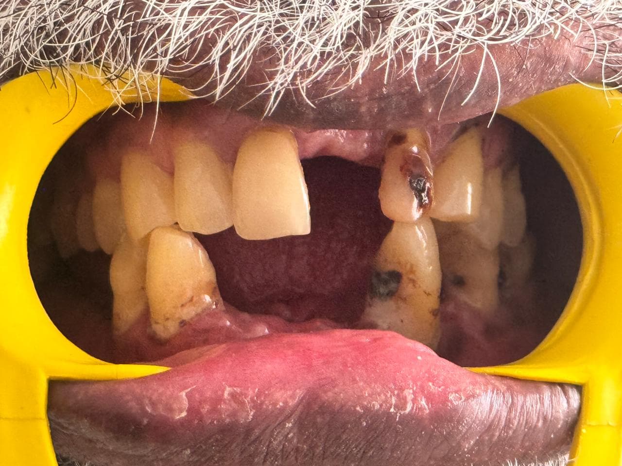 Before crowns & bridges at Dent Health, Banjara Hills, Hyderabad - Missing and decayed upper teeth rebuilt with a full set of crowns and a fixed bridge. Drag to compare. Before crowns & bridges at Dent Health, Banjara Hills, Hyderabad - Missing and decayed upper teeth rebuilt with a full set of crowns and a fixed bridge. Drag to compare.