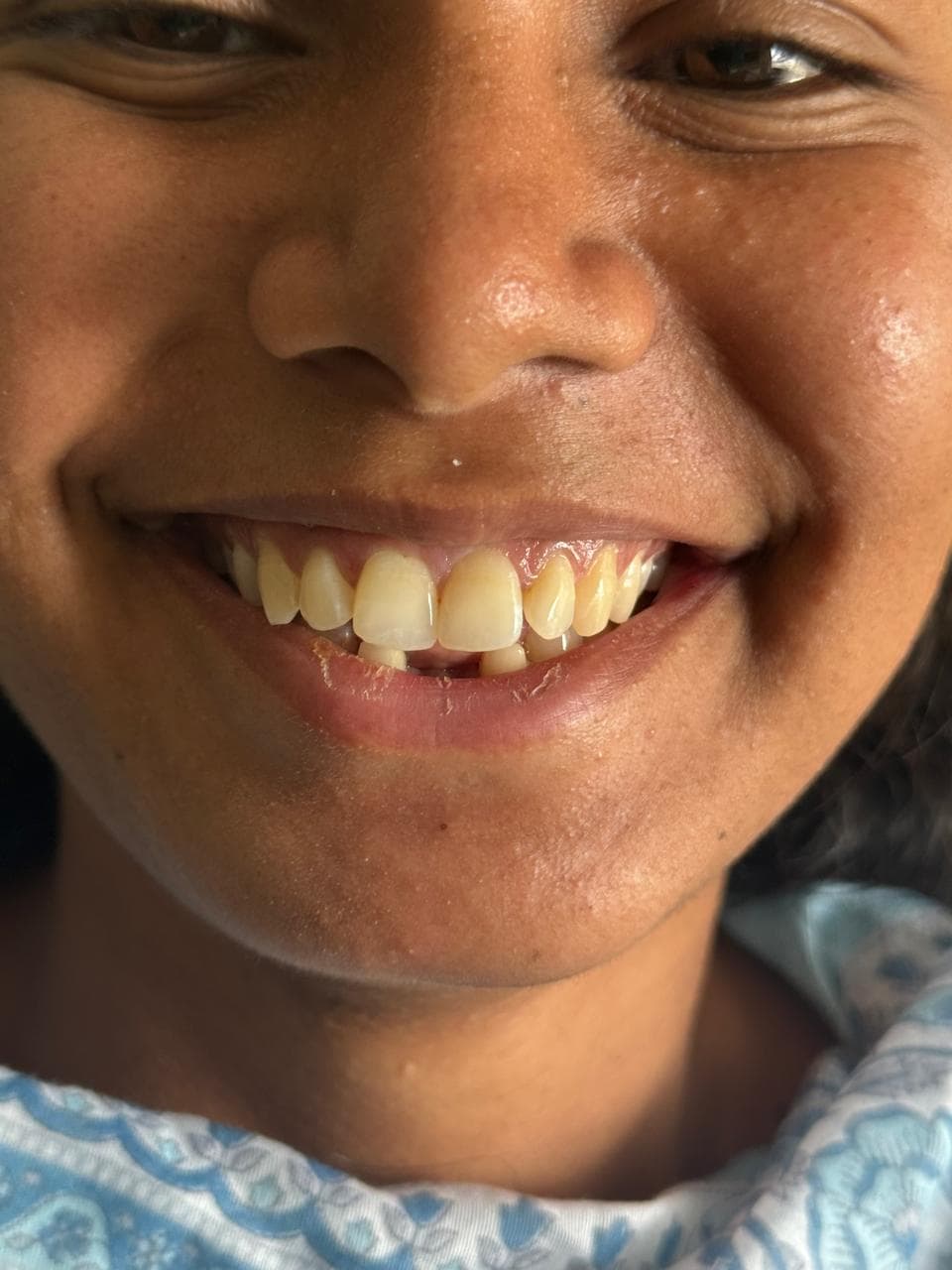 Before - crowns & bridges at Dent Health, Banjara Hills, Hyderabad Before - crowns & bridges at Dent Health, Banjara Hills, Hyderabad