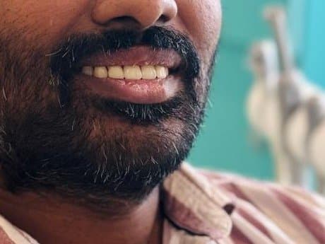 After crowns & bridges at Dent Health, Banjara Hills, Hyderabad - Several missing front teeth replaced with permanent crowns for a complete, natural smile. Drag to compare. After crowns & bridges at Dent Health, Banjara Hills, Hyderabad - Several missing front teeth replaced with permanent crowns for a complete, natural smile. Drag to compare.