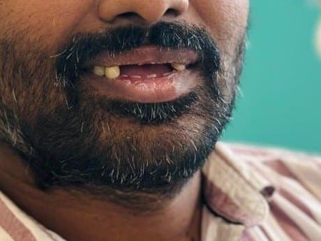 Before crowns & bridges at Dent Health, Banjara Hills, Hyderabad - Several missing front teeth replaced with permanent crowns for a complete, natural smile. Drag to compare. Before crowns & bridges at Dent Health, Banjara Hills, Hyderabad - Several missing front teeth replaced with permanent crowns for a complete, natural smile. Drag to compare.