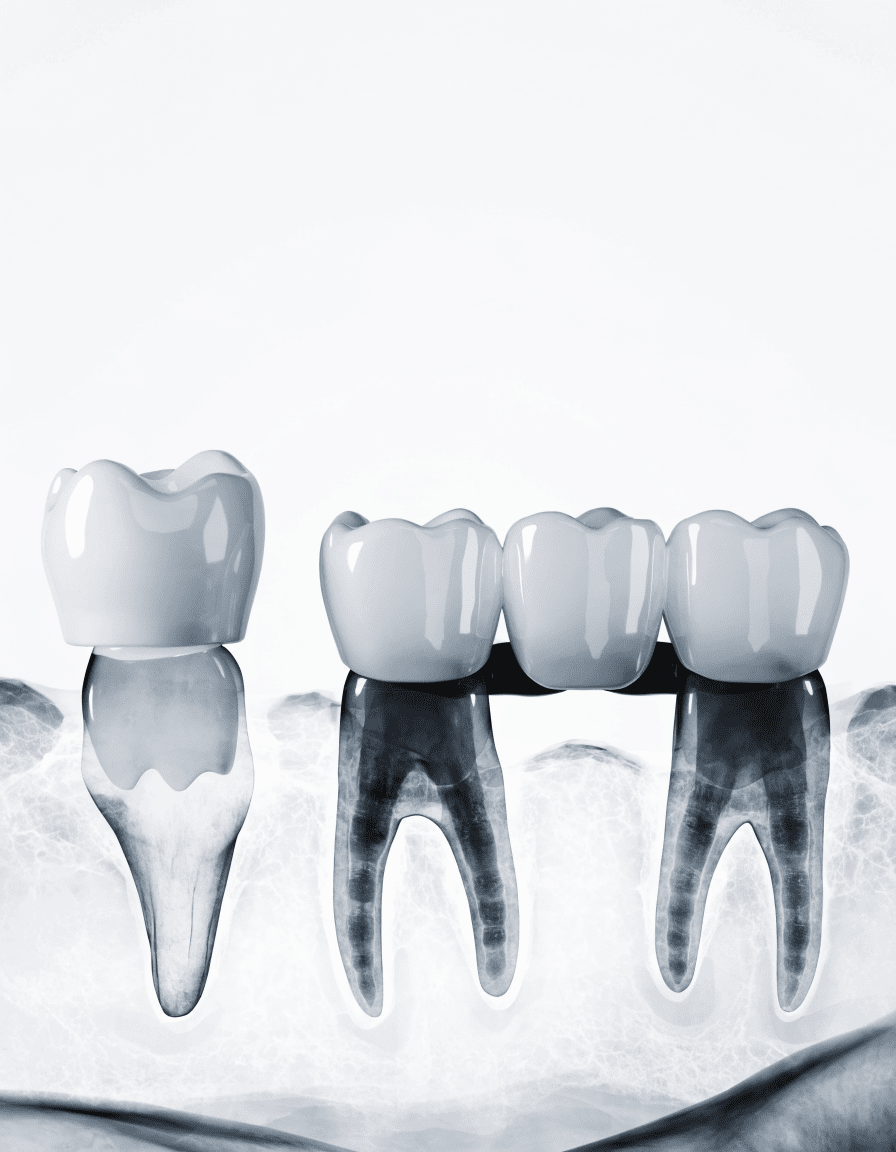 Crowns & Bridges in Banjara Hills, Hyderabad - Dent Health Crowns & Bridges in Banjara Hills, Hyderabad - Dent Health