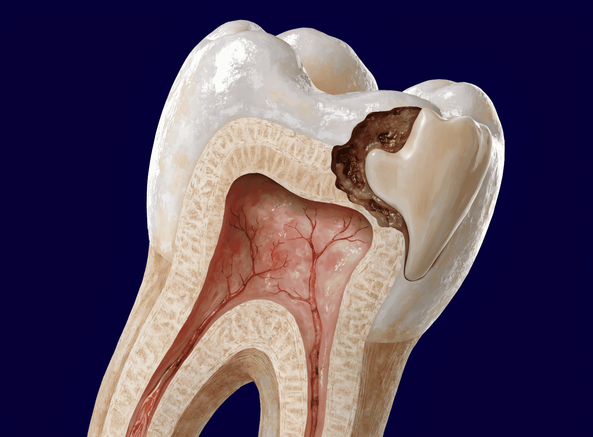 Anatomical cutaway of a molar with decay removed and the cavity restored with composite filling Anatomical cutaway of a molar with decay removed and the cavity restored with composite filling