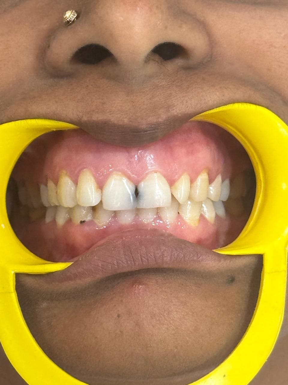 Before - dental filling at Dent Health, Banjara Hills, Hyderabad Before - dental filling at Dent Health, Banjara Hills, Hyderabad