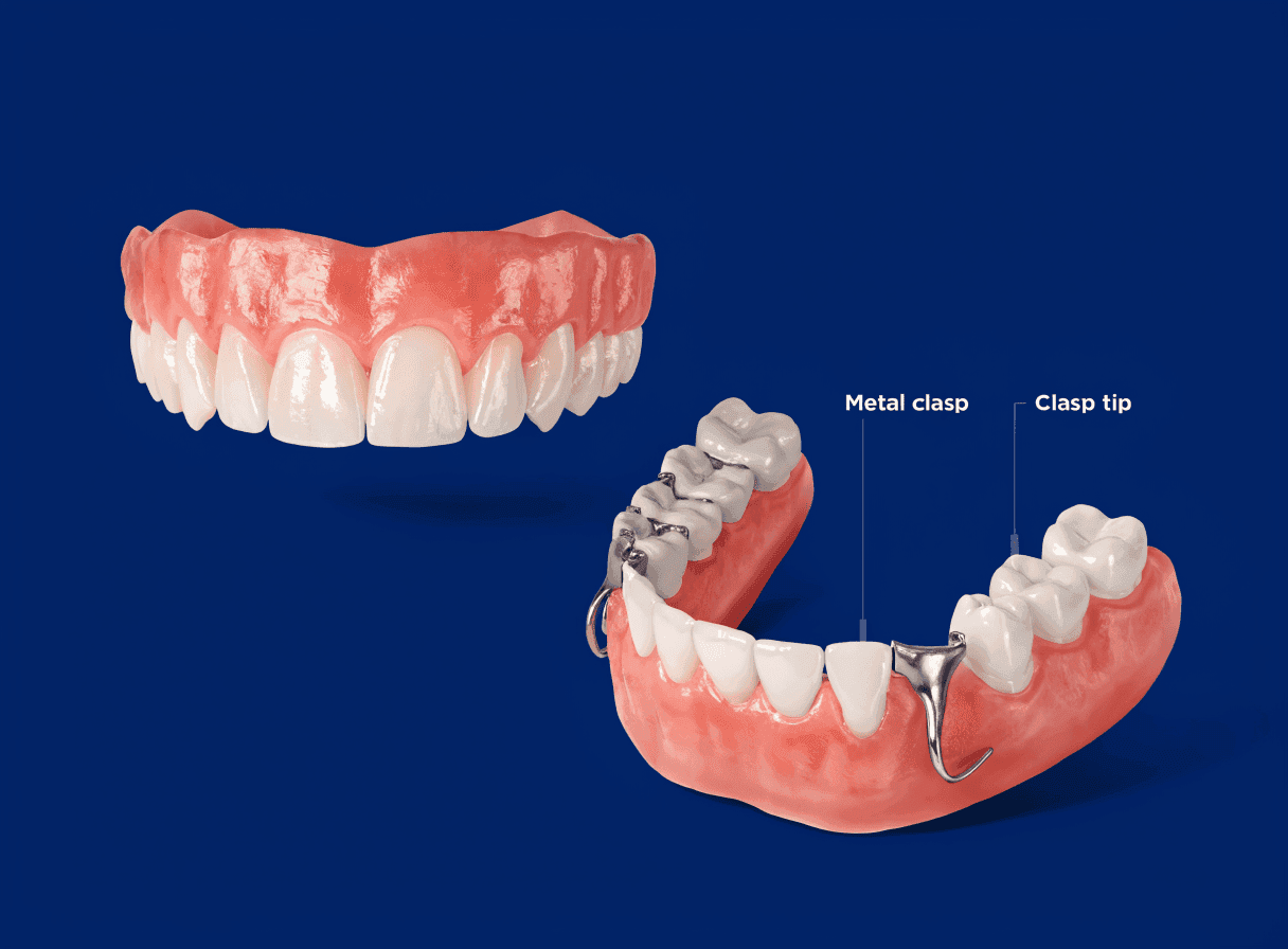 Anatomical illustration of a full denture and a partial denture seated over the gum ridge Anatomical illustration of a full denture and a partial denture seated over the gum ridge