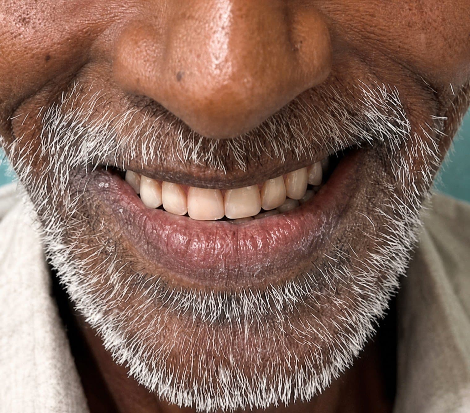 After dentures at Dent Health, Banjara Hills, Hyderabad - Collapsed lips from missing teeth filled out with a full, natural-looking denture. Drag to compare. After dentures at Dent Health, Banjara Hills, Hyderabad - Collapsed lips from missing teeth filled out with a full, natural-looking denture. Drag to compare.
