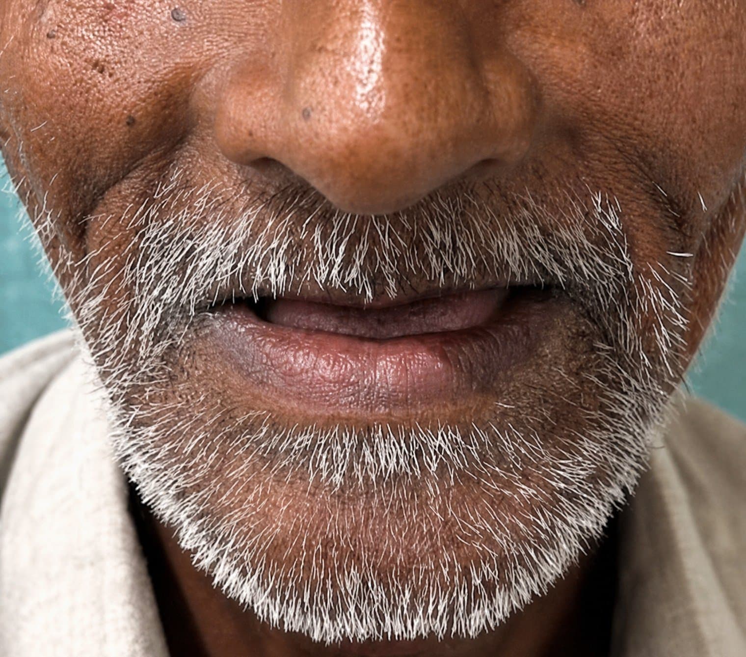 Before dentures at Dent Health, Banjara Hills, Hyderabad - Collapsed lips from missing teeth filled out with a full, natural-looking denture. Drag to compare. Before dentures at Dent Health, Banjara Hills, Hyderabad - Collapsed lips from missing teeth filled out with a full, natural-looking denture. Drag to compare.