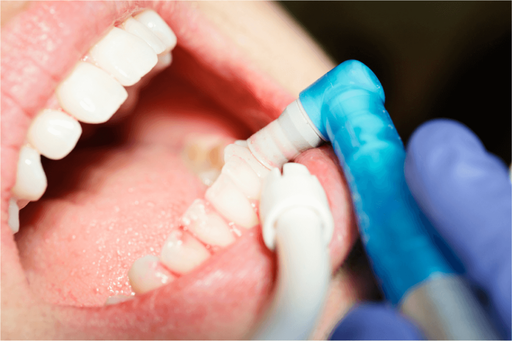 Uncovering The Hidden Dangers 6 Signs Of Infection After Root Canal Treatment